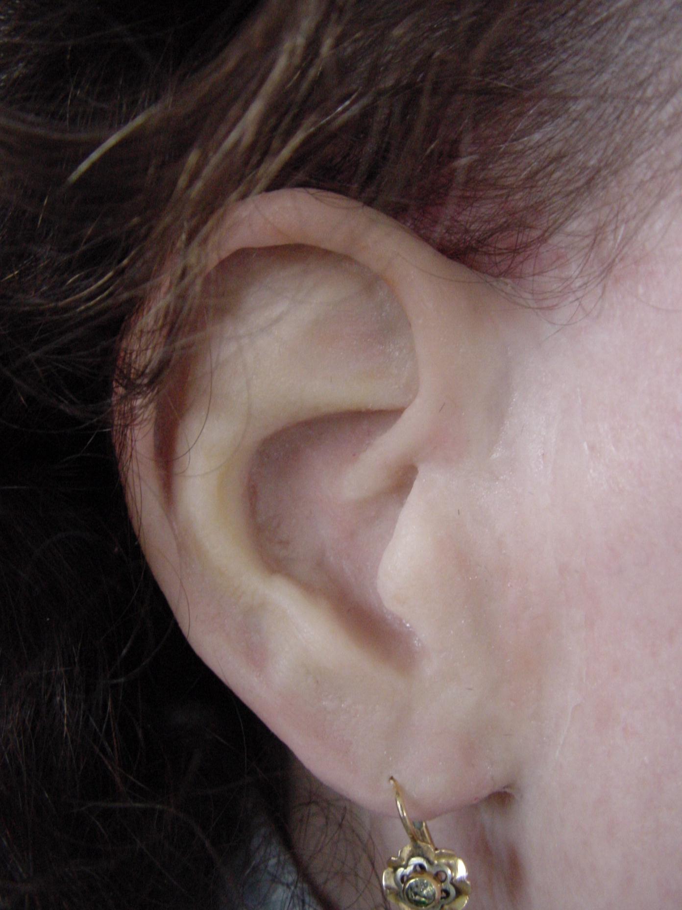 Ohrepithese  Epitheseninstitute Schneider